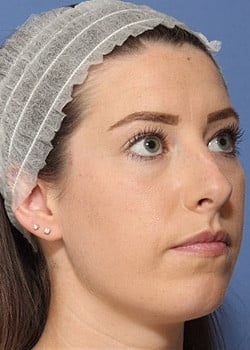 Before Image: Rhinoplasty - front