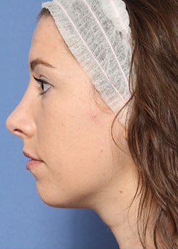 After Image: Rhinoplasty - front