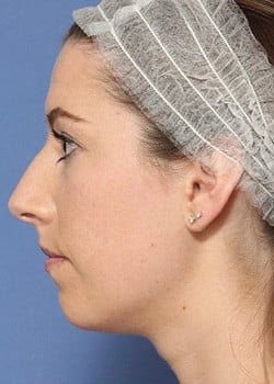 Before Image: Rhinoplasty - front