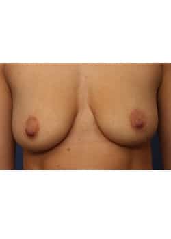 Before Image: Breast Implant Placement - front