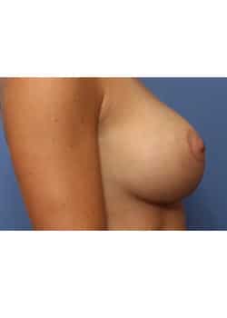 After Image: Breast Implant Placement - front