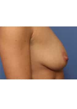 Before Image: Breast Implant Placement - front