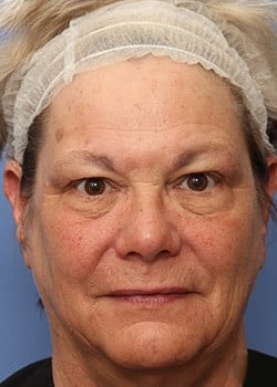 Before Image: Facelift - front