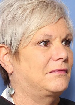 After Image: Facelift - front