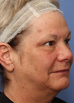 Before Image: Facelift - front