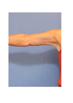 After Image: Brachioplasty - front