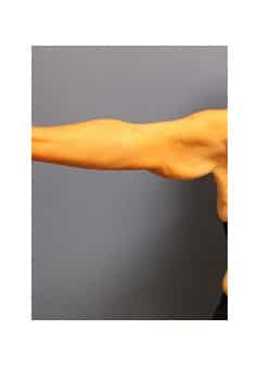 Before Image: Brachioplasty - front