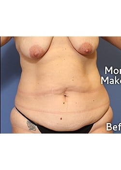 Before Image: Mommy Makeover Case 10 - front