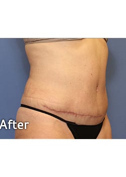 After Image: Mini Abdominoplasty - front