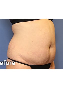 Before Image: Mini Abdominoplasty - front