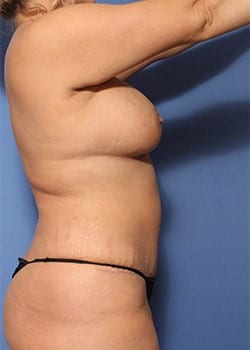 After Image: Mommy Makeover Case 11 - right-side