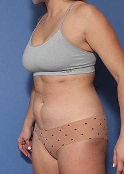 Before Image: HD Vaser - left-front-oblique