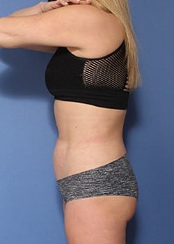 After Image: HD Vaser - left-side