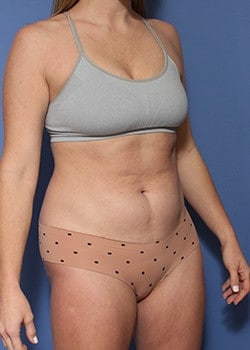 Before Image: HD Vaser - right-front-oblique