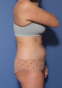 Before Image: HD Vaser - right-side