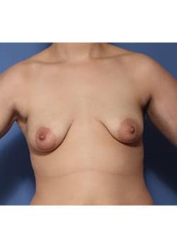 Before Image: Breast Lift with Augmentation - front