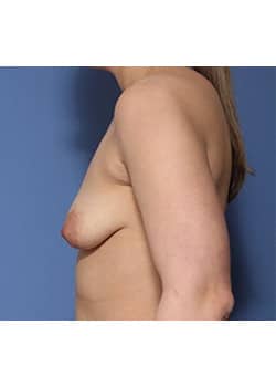 Before Image: Breast Lift with Augmentation - left-front-oblique