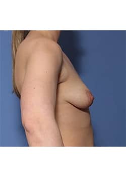 Before Image: Breast Lift with Augmentation - right-side