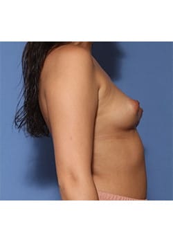Before Image: Breast Lift with Augmentation - right-side