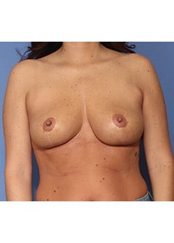 Breast Lift