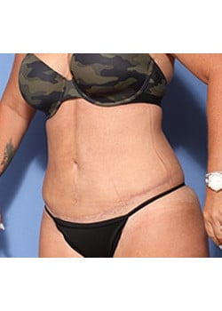 After Image: Tummy Tuck - left-front-oblique