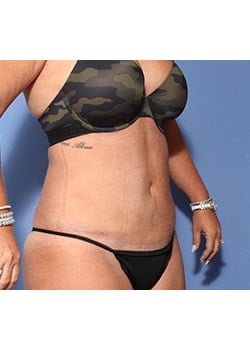 After Image: Tummy Tuck - right-front-oblique