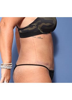After Image: Tummy Tuck - right-side