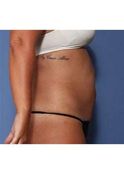 Before Image: Tummy Tuck - right-side
