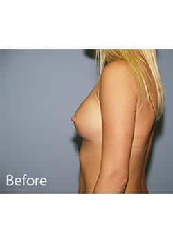 Breast Revision