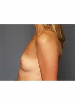 Breast Augmentation
