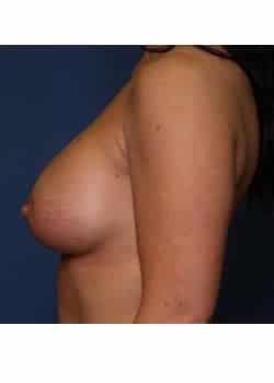 Breast Augmentation