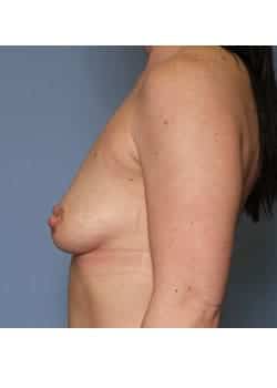 Breast Augmentation