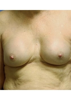 Before Image: Breast Revision - front