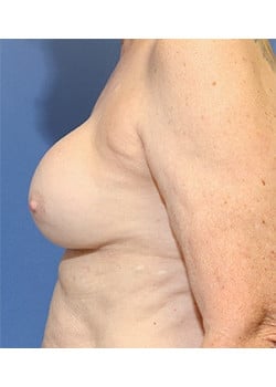 Before Image: Breast Revision - left-side