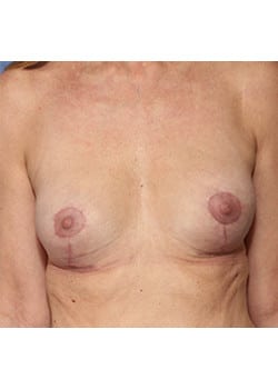 After Image: Breast Revision - front