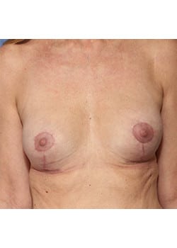 Breast Revision