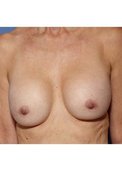 Before Image: Breast Revision - front