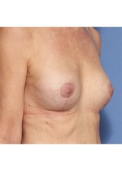 After Image: Breast Revision - right-front-oblique