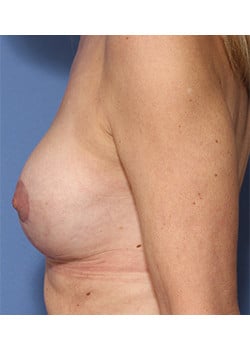 After Image: Breast Revision - left-side