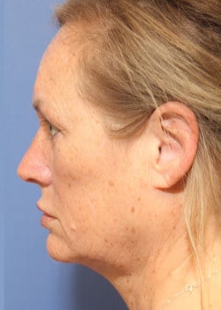 Before Image: Fusion Facelift Case 4 - other