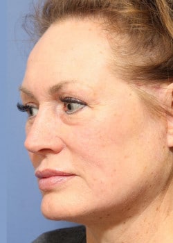 Fusion Facelift Case 4