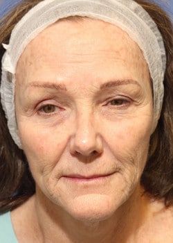 Before Image: Fusion Facelift Case 5 - front