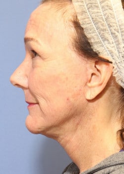 After Image: Fusion Facelift Case 5 - left-side