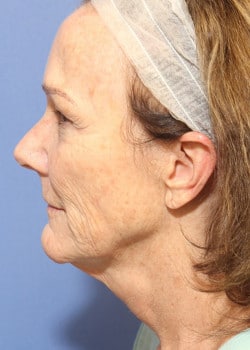 Before Image: Fusion Facelift Case 5 - left-side