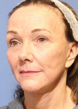 After Image: Fusion Facelift Case 5 - left-front-oblique