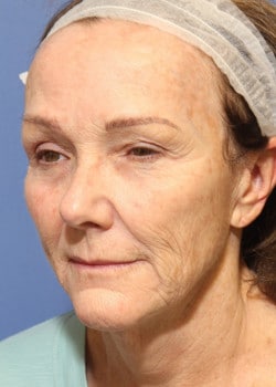 Before Image: Fusion Facelift Case 5 - left-front-oblique