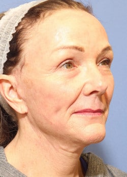 After Image: Fusion Facelift Case 5 - right-front-oblique