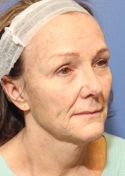 Before Image: Fusion Facelift Case 5 - right-front-oblique