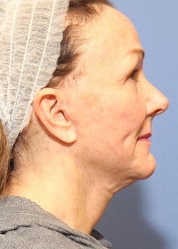 After Image: Fusion Facelift Case 5 - right-side
