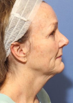 Before Image: Fusion Facelift Case 5 - right-side